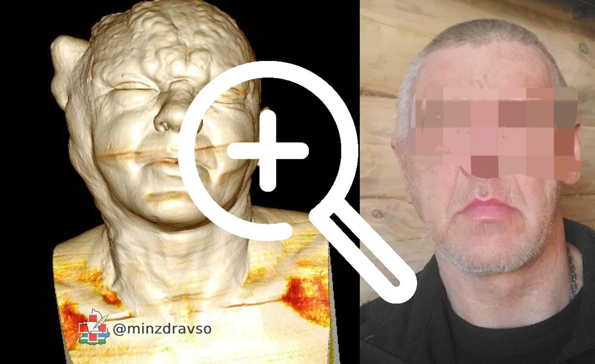 Врачи из Урала успешно исправили серьезные повреждения...