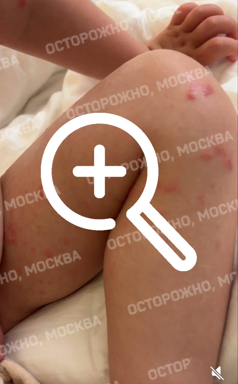 Туристы из Москвы, отдыхающие в Турции, сообщают о вспышке вируса Коксаки в отеле «Sunlight resort» на юге страны.