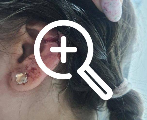 В Амурской области игравшая на детской площадке девочка едва не оторвала себе ухо