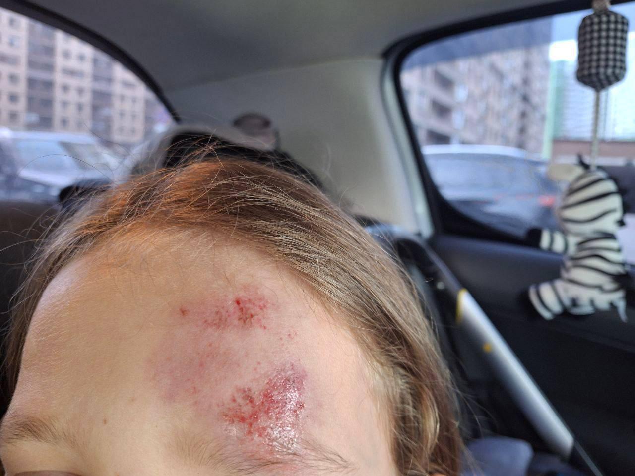 На Европейском проспекте мужчина на СИМ сбил 8-летнюю девочку и скрылся. У ребёнка — ушибы и ссадины.