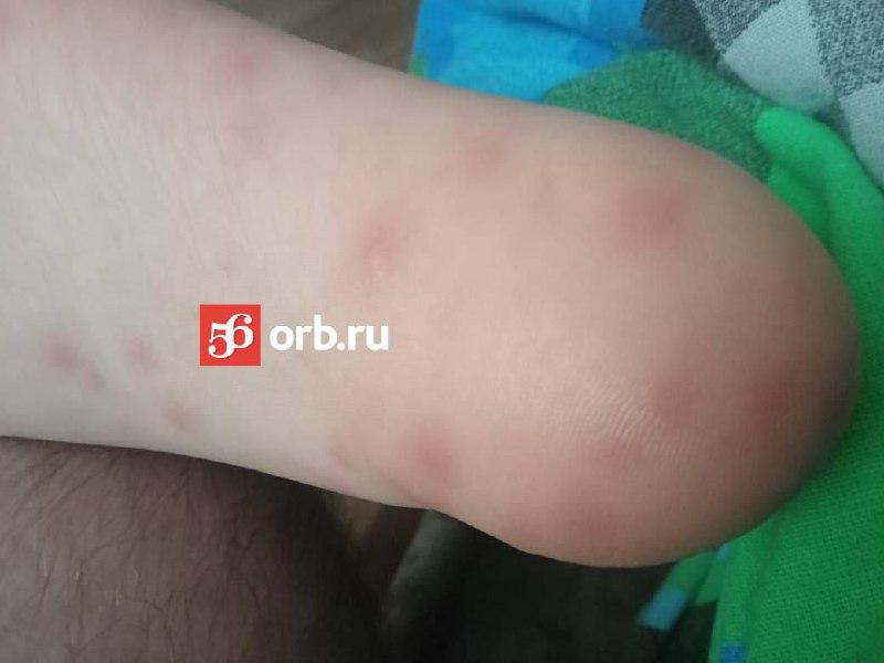 ❗️В Оренбурге ребенок покрылся сыпью после купания в...