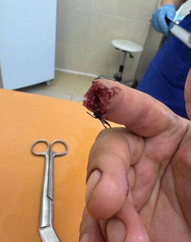В Хабаровске собака бойцовской породы оторвала палец мужчине.
