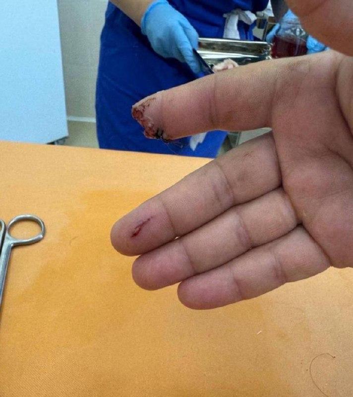 В Хабаровске собака бойцовской породы оторвала палец мужчине.