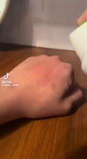 Девочка хотела повторить тренд из «ТикТока» и прожгла свою руку дезодорантом....
