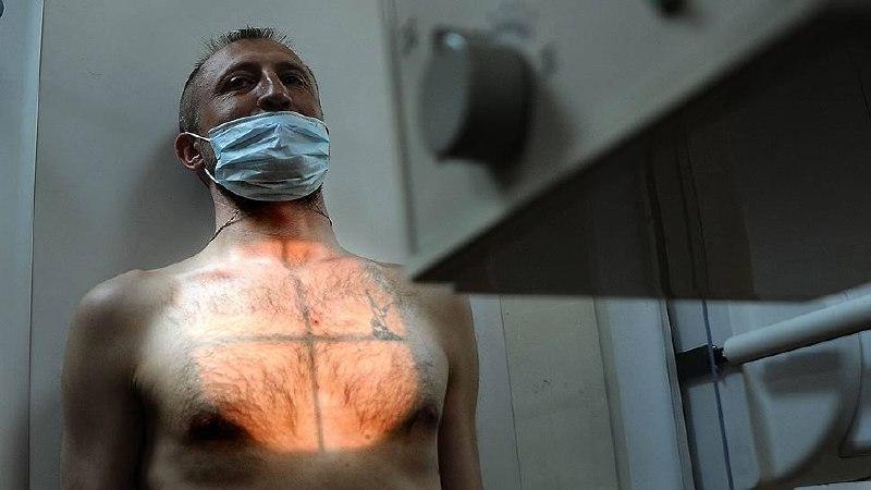 Больного туберкулезом пришлось насильно госпитализировать