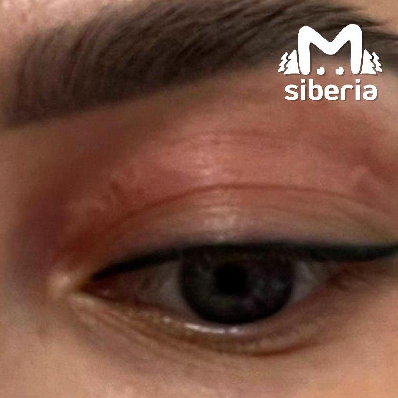 Червя в глазу привезла из отпуска томичка. Пассажир ехал безбилетником у неё под кожей.