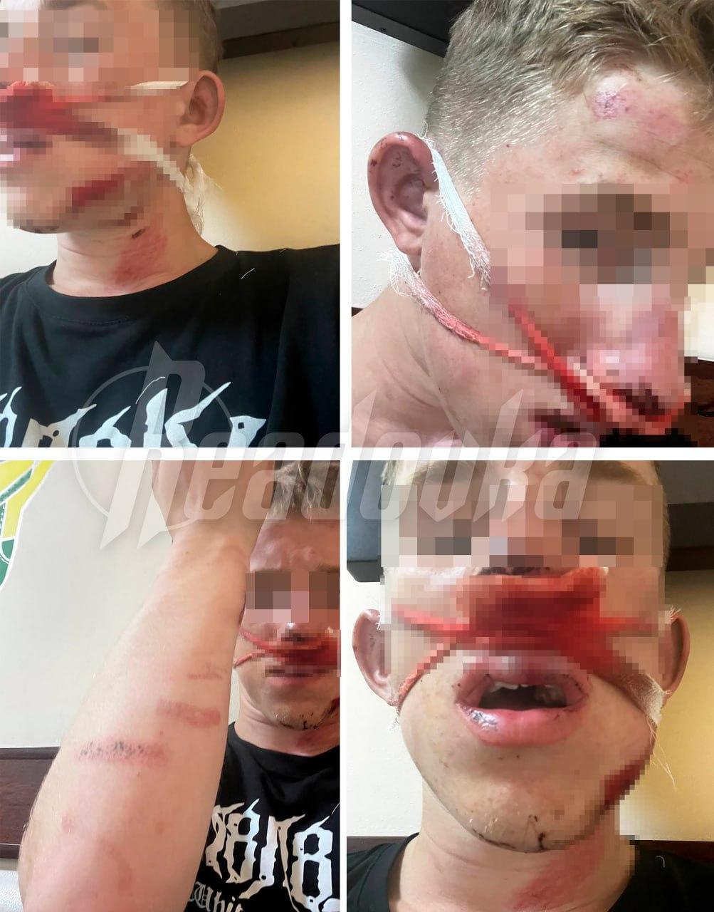На Сахалине толпа из 30 человек напала на подростков — одного из ребят закидали булыжниками и обокрали