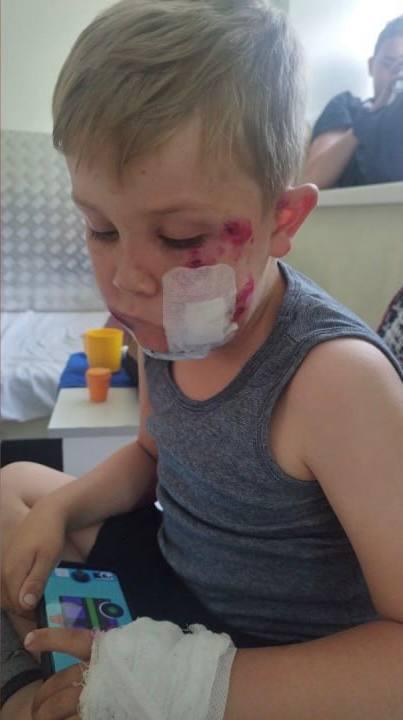 Пёс изуродовал лицо 4-летнего ребёнка на пути к пляжу под Петербургом
