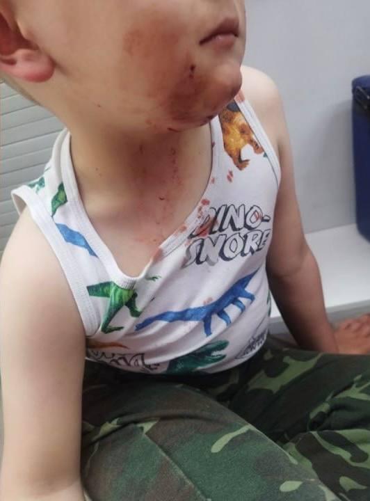 Пёс изуродовал лицо 4-летнего ребёнка на пути к пляжу под Петербургом