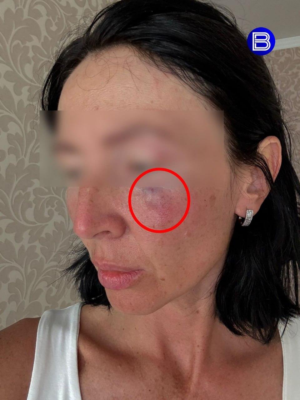 В Новосибирске конфликт из-за детского сачка на пляже закончился избиением