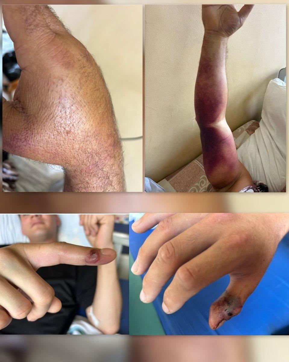 🐍🚑Более 20 человек стали пациентами Тысячекоечной больницы после встречи с ядовитыми змеями