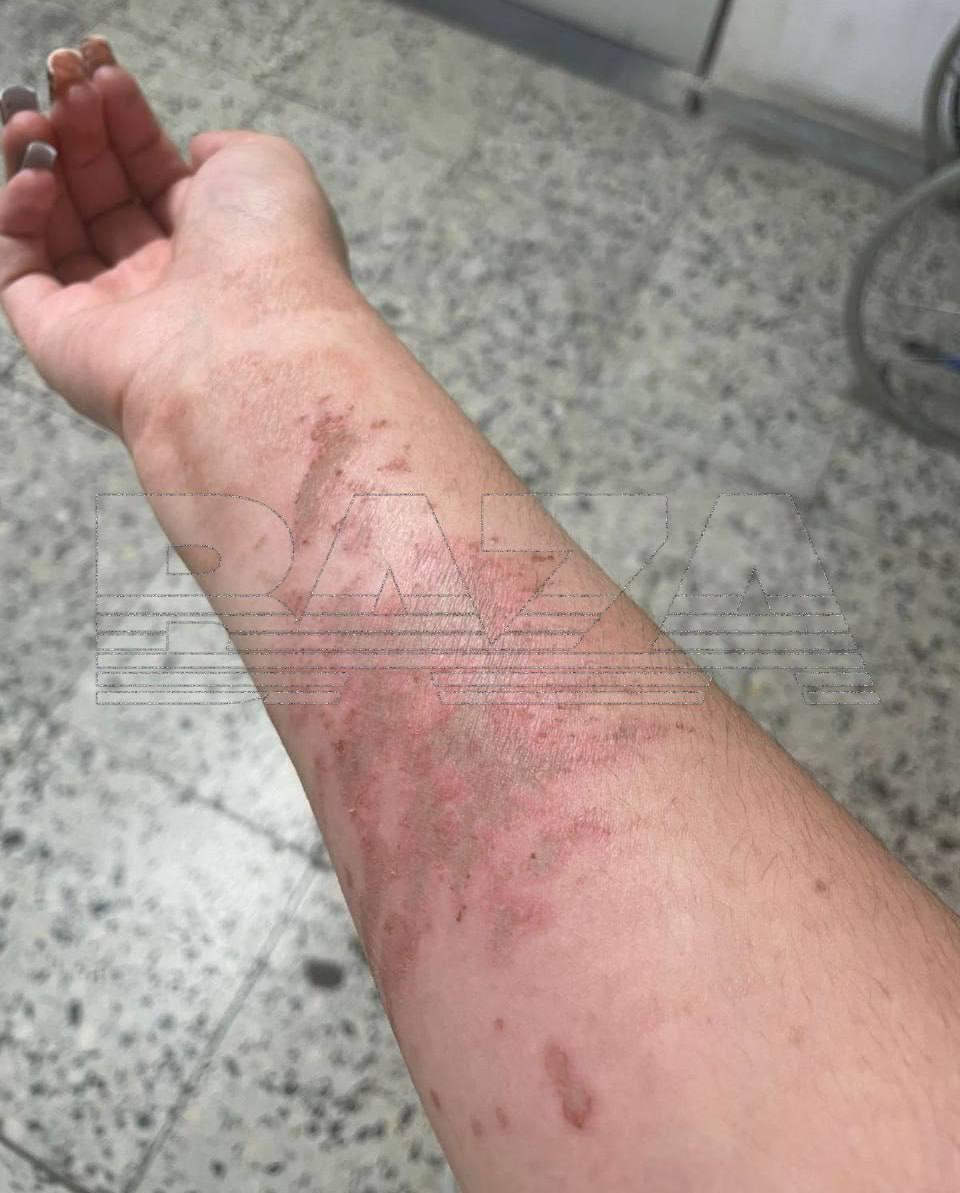 Сотруднице на сельхозпредприятии в Ленобласти, прыснула серная кислота на...