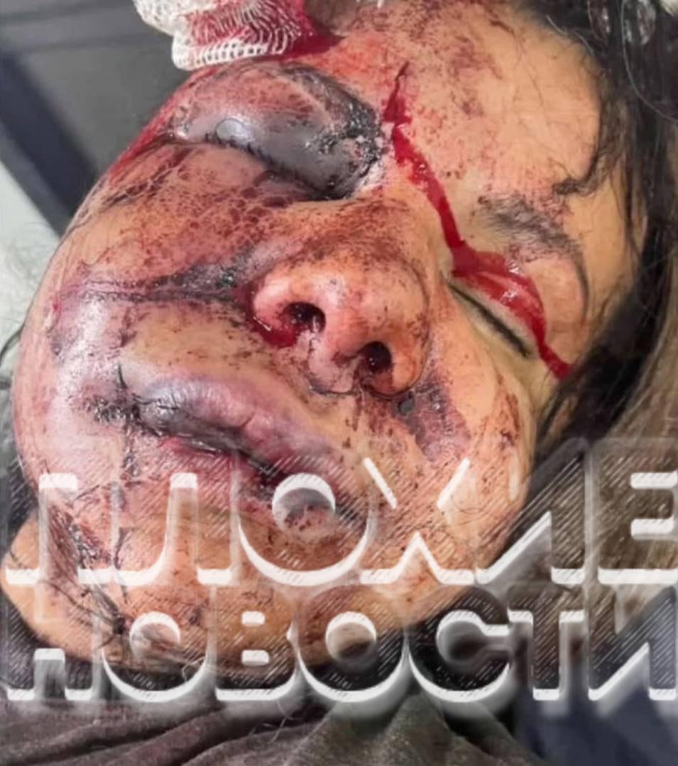 В Бразилии ревнивый спортсмен зверски избил молодую девушку, заподозрив ее в измене с поклонниками в соцсетях: у пострадавшей изуродована внешность