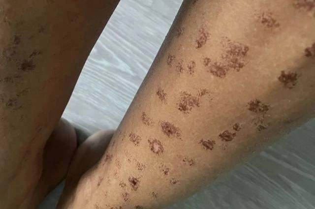 В Новосибирске девушка получила ожоги после лазерной эпиляции