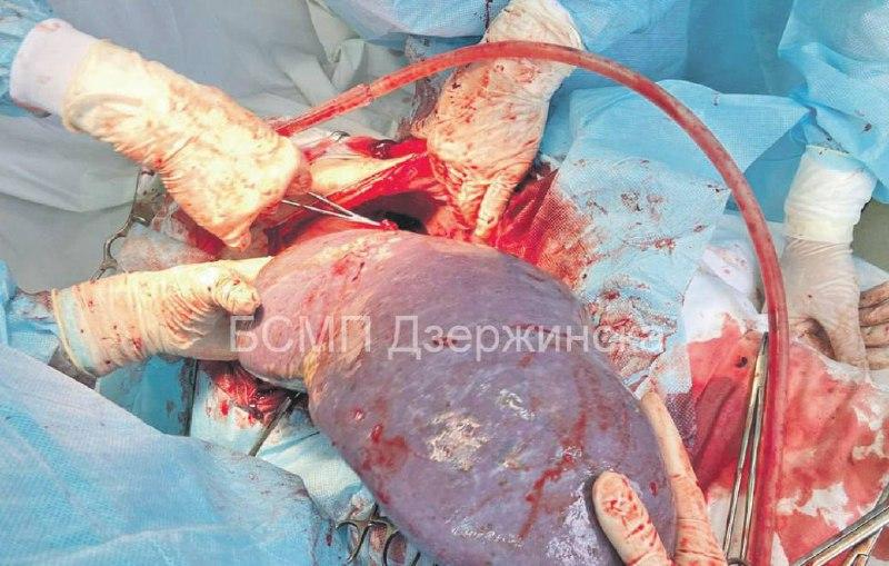 Гигантскую селезёнку вырезали нижегородские врачи у пациентки. Это первая подобная операция в области