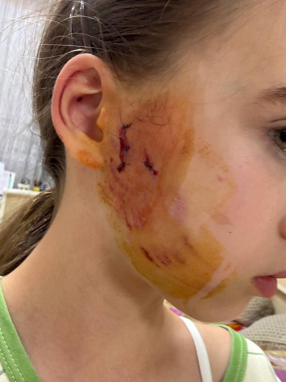 В Калининграде бойцовская собака разорвала лицо 12-летней девочке