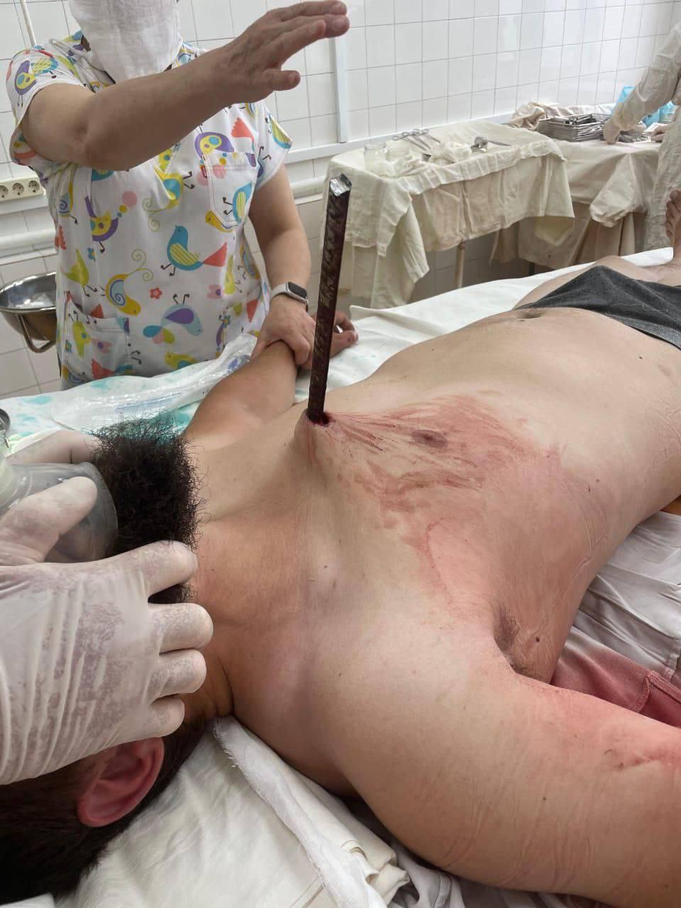 В Дагестане 24-летний рабочий выжил после падения на металлический прут, он...