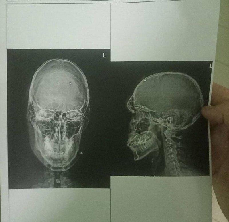 🤬 Группа подростков 15-16 лет жестко избили 21-летнего парня во время конфликта в Артёме. После этого они выстрелили в него из травмата несколько раз. Возбуждено уголовное дело по статье «Покушение на убийство». Подозреваемых ищут, сообщает СК Приморья.