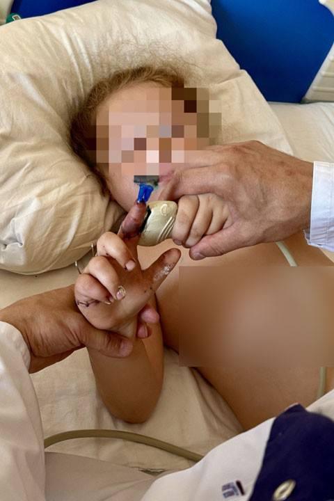 6-летней девочке успешно пришили палец, пострадавший от рук отчима