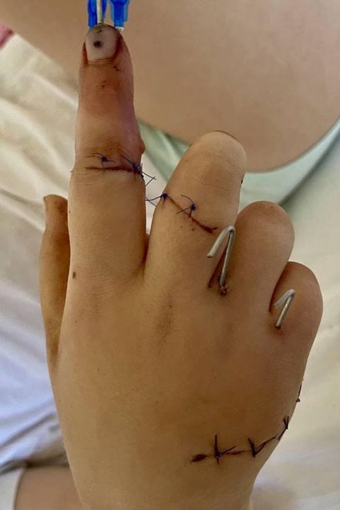 6-летней девочке успешно пришили палец, пострадавший от рук отчима