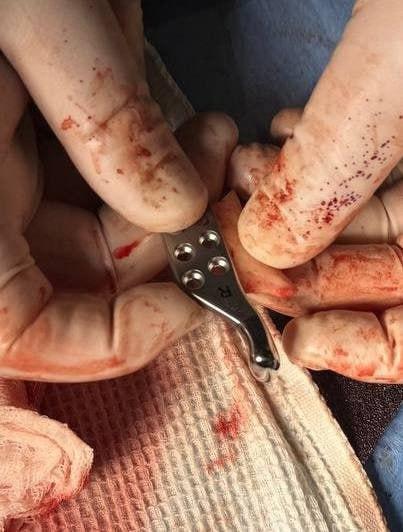 Красноярские врачи заменили кость челюсти пациента на металлическую Мужчина...