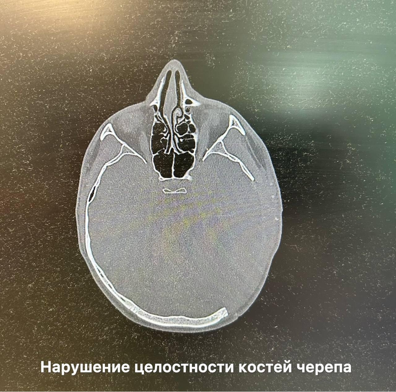 🗣Во Владивостоке врачи спасли 18-летнего парня, который проломил себе череп и сломал кости, врезавшись на электросамокате в автомобиль