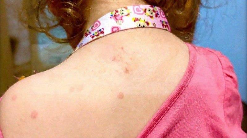 В Красноярском крае фиксируются случаи вируса коксаки у детей.
