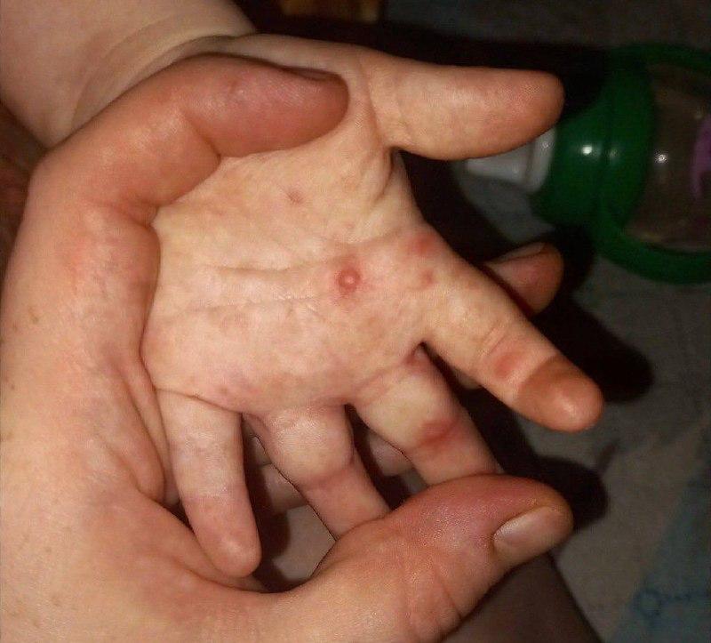 В Красноярском крае фиксируются случаи вируса коксаки у детей.