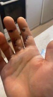 Аппарат для хинкали зажевал руку повара