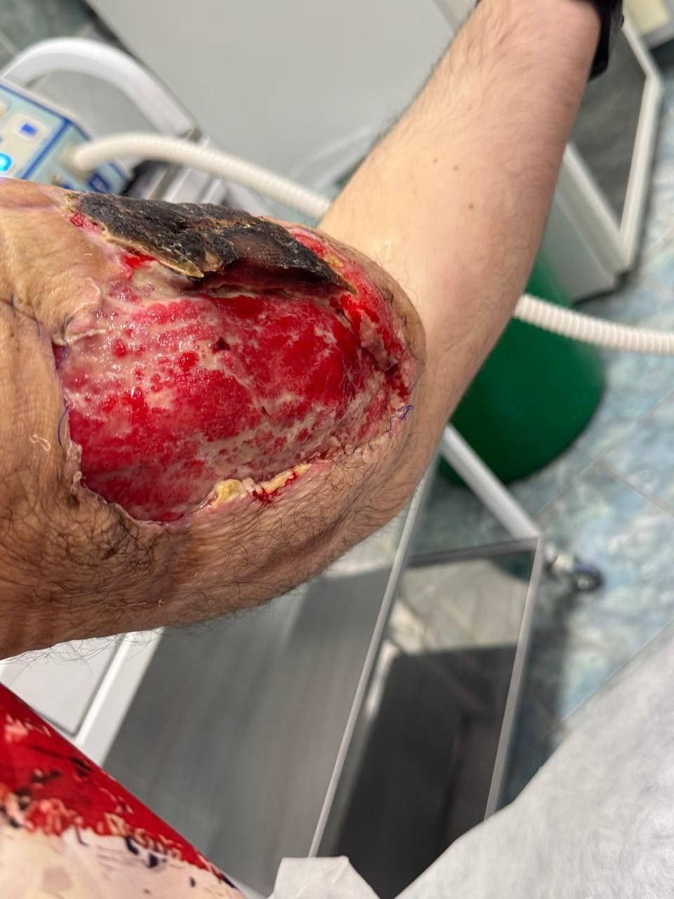 У 29-летнего Кирилла Терёшина начала гнить рука. В своё время парень...