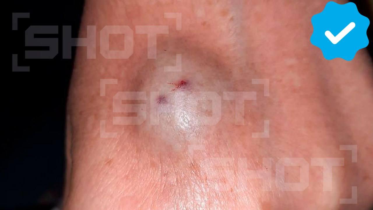 Здоровая шишка выросла у россиянки после нападения неизвестного насекомого в Египте. Вероятнее всего, это был ночной верблюжий паук